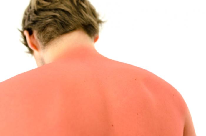 Are You Getting Sunburns? Here Are Some Natural Remedies For You To Try -  1mg Capsules