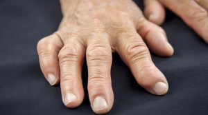 a person suffering from arthritis - Dealing with arthritis