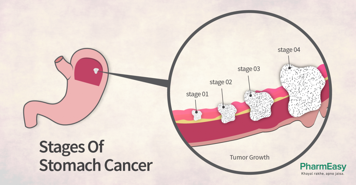 Causes and Symptoms of Stomach Cancer