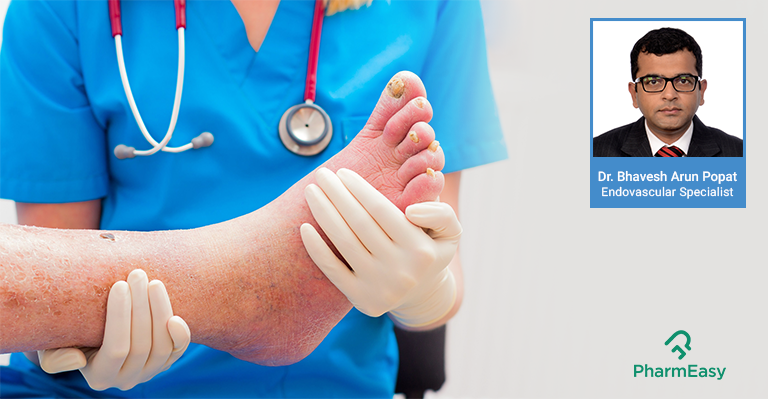 Diabetes related amputations