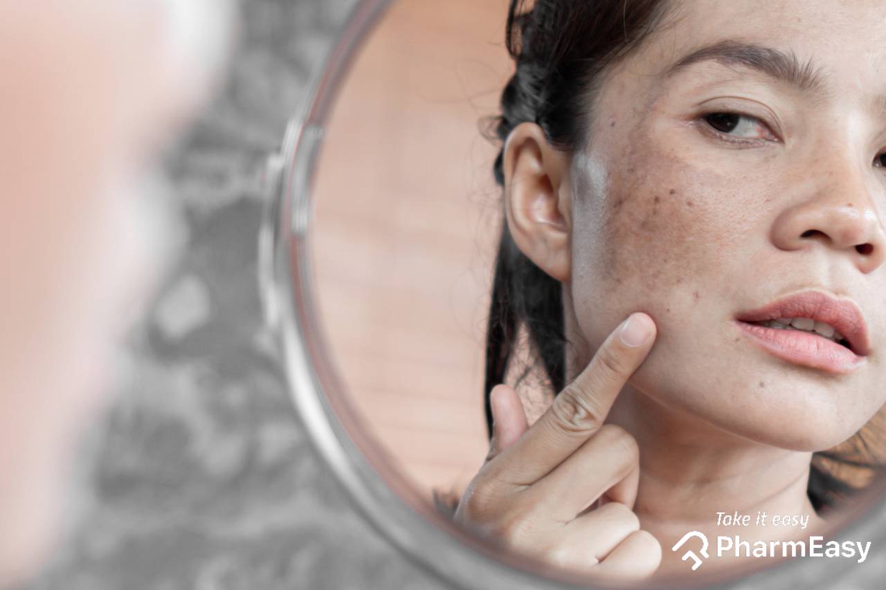 Best Ways to Reduce Dark Spots On The Face - PharmEasy Blog | wellhealthorganic.com:lemon-juice-know-home-remedies-easily-remove-dark-spots