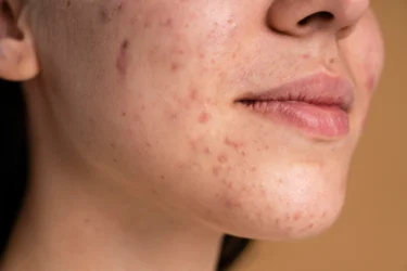 woman with acne 