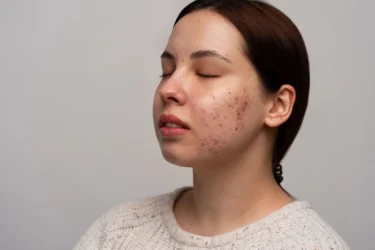 blemishes 
