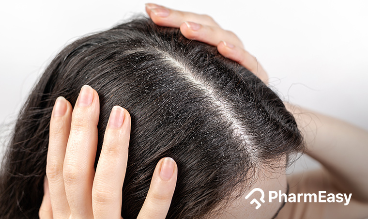 Scalp Flakes in Hair: Dandruff and 8 Other Causes