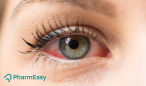 home remedies for red eyes