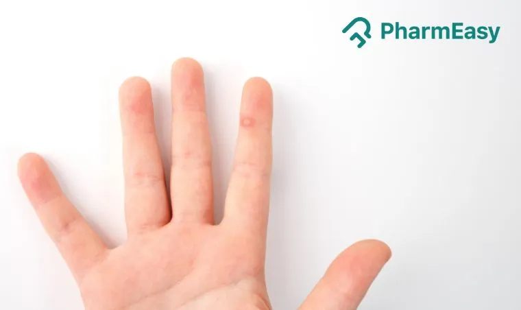 Easy Home Remedies for Wart Removal: Effective & Safe Options