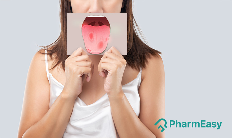 Simple Home Remedies for Tongue Ulcers - PharmEasy Blog
