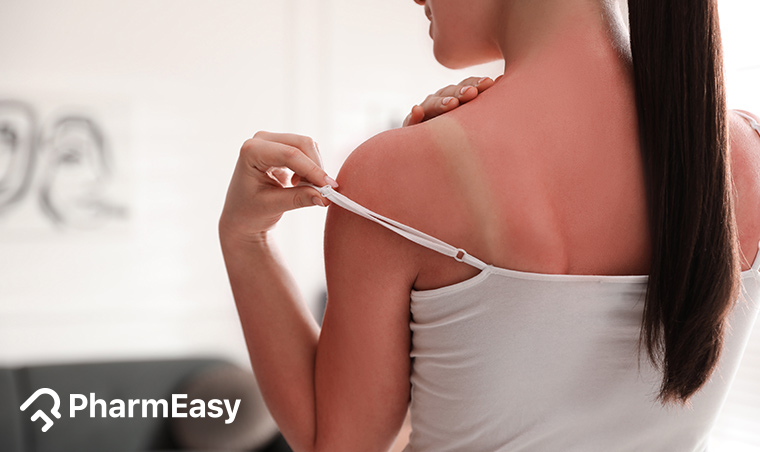 Best Home Remedies for Sunburn - PharmEasy Blog