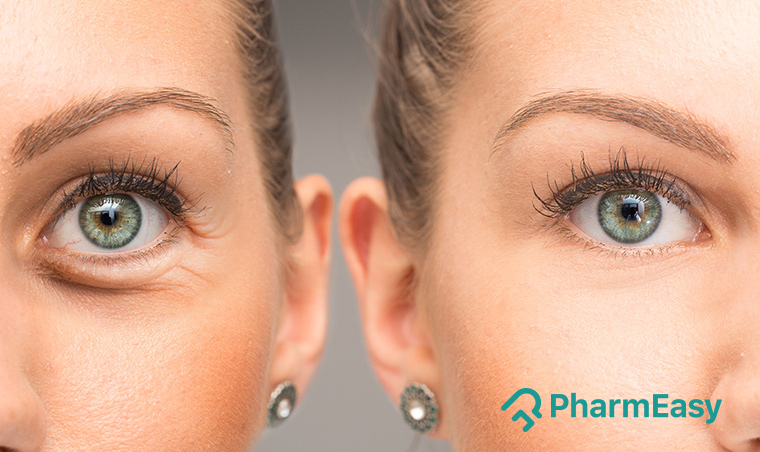 Simple Home Remedies For Puffy Eyes - PharmEasy Blog