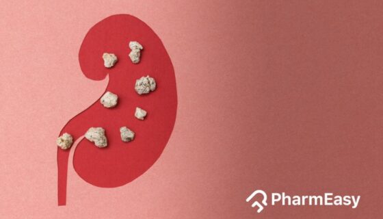 home remedies for kidney stones