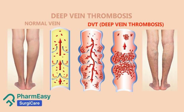 Deep Vein Thrombosis, DVT Symptoms, Causes And, 58% OFF