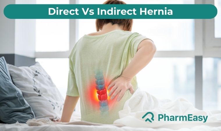 Difference between Direct vs Indirect Hernia - PharmEasy Blog