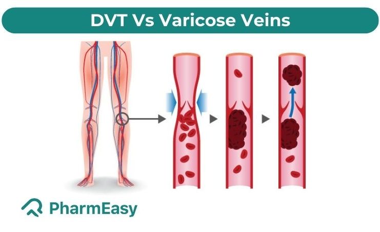 deep vein thrombosis vs varicose veins