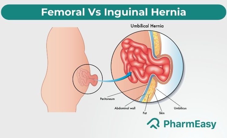 Difference Between Femoral And Inguinal Hernia - PharmEasy Blog