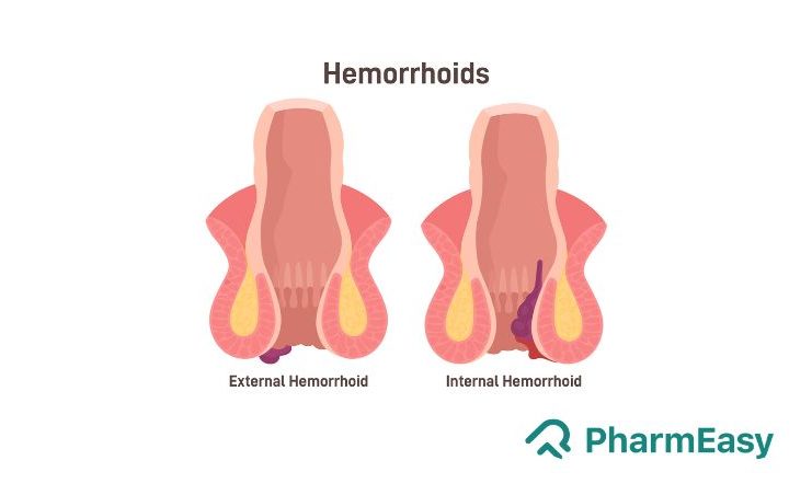 prolapsed hemorrhoid vs external