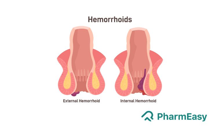 Haemorrhoids usually develop when the tissues supporting the anal opening deteriorate or disintegrate, leading to swollen blood vessels.