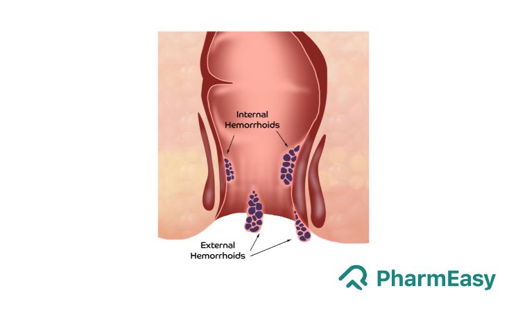 What is Piles, causes and treatment 