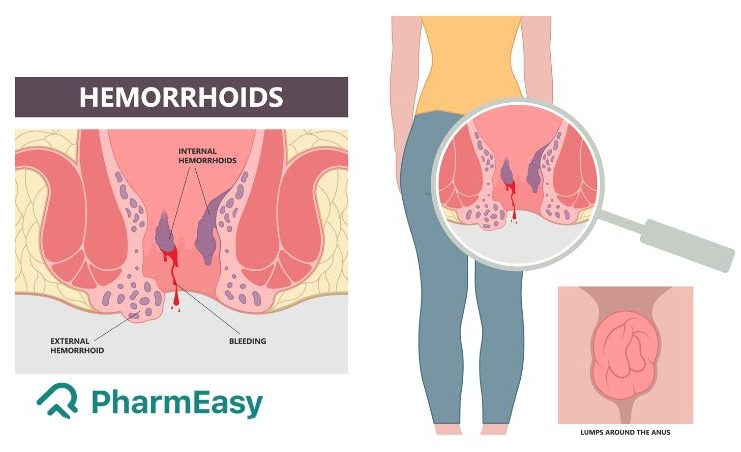 Easy Ways To Remove External Haemorrhoids At Home - PharmEasy Blog