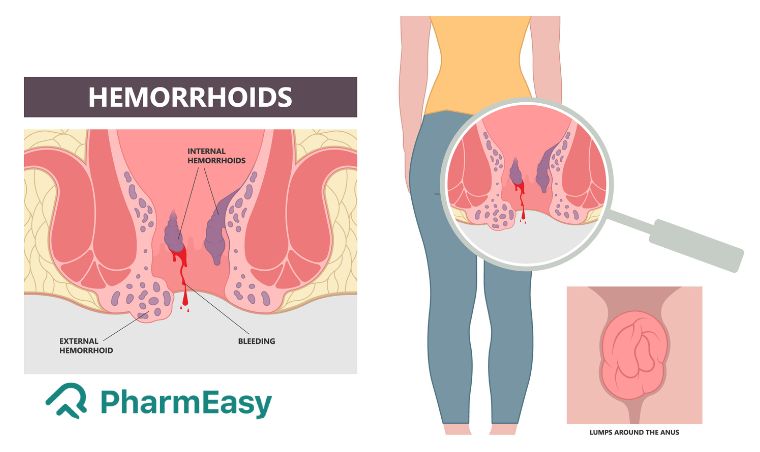 External haemorrhoids are a common condition affecting the general population.