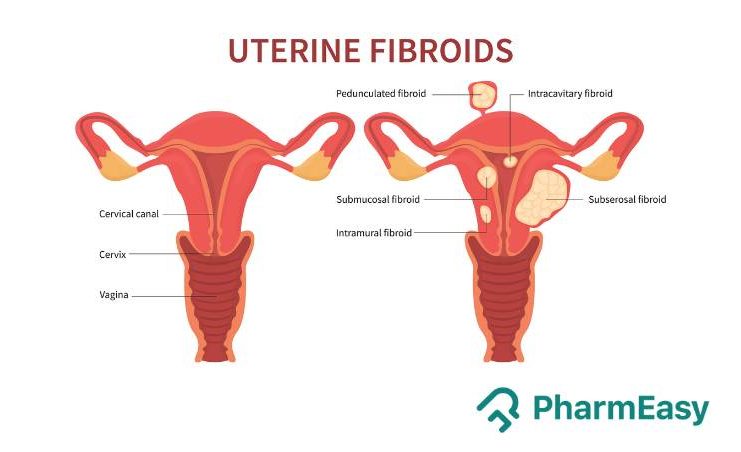 intramural fibroid