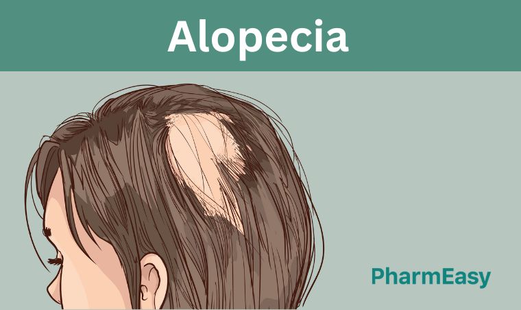 Understanding Alopecia: Signs, Symptoms And Causes