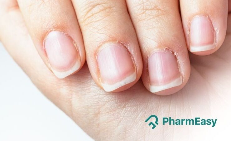 6 Signs of a Vitamin Deficiency in Your Nails | livestrong