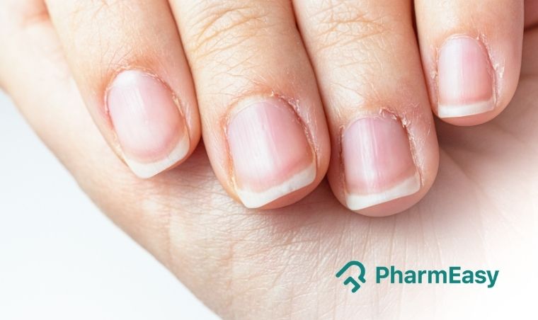 White Spots on Nails 'Leukonychia' - How to Get Rid of These? - Health &  Wellness Blog | Healthwire
