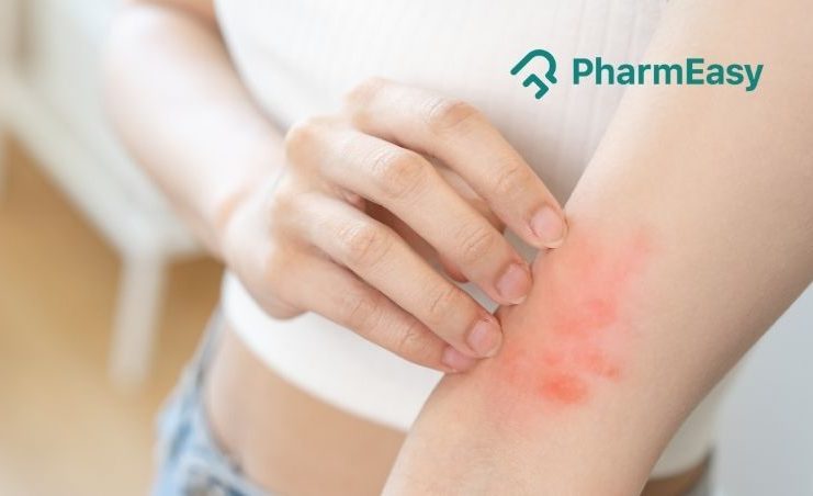 Red Spots on Symptoms, and Research-Based Treatment Strategies - PharmEasy