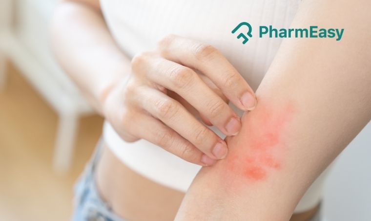 Pityriasis Rosea Condition, Treatments and Pictures for Adults - Skinsight