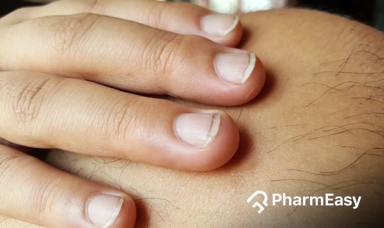 Dr. Eric Berg - BRITTLE NAILS OR RIDGED NAILS The most likely cause is high  estrogen. Explanation: This symptom could be related to a thyroid imbalance  since nails are made from collagen.