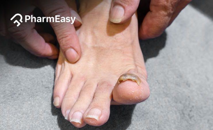 What Causes Thick Toenails: Understanding the Possible Underlying  Conditions - PharmEasy Blog