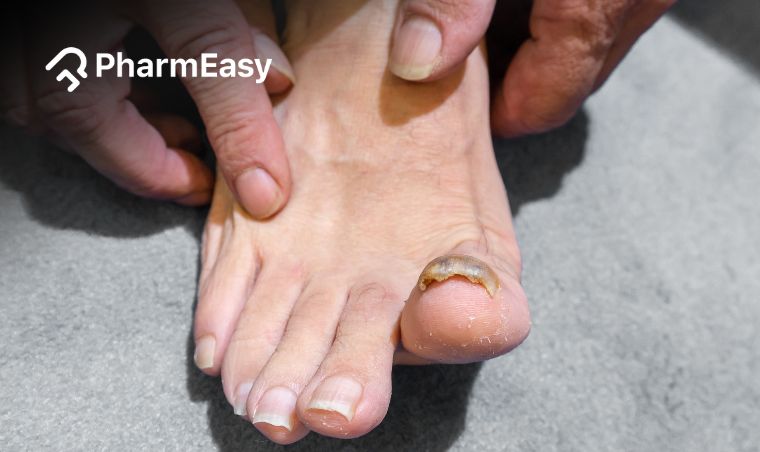 Fungal Nail Infection, symptoms, causes, prevention & treatment