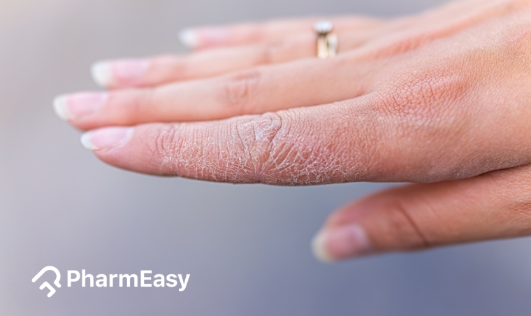 Dry Hands: Effective Solutions and Research-Based Skincare Tips