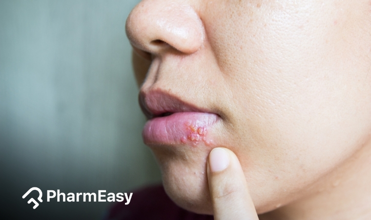 Pimples on Lips: Causes, Prevention, and Effective Treatments