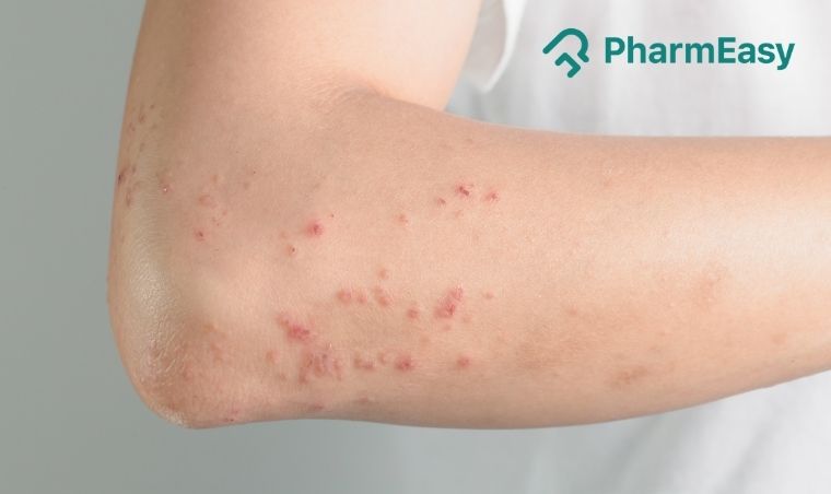 Are Hives Contagious? Unravelling the Facts Behind Skin Allergies 