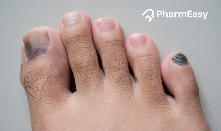 Why are My Toenails Black: Unraveling the Causes and Management Options