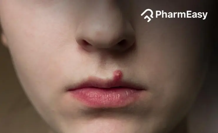 Pimples on Lips: Causes, Prevention, and Effective Treatments