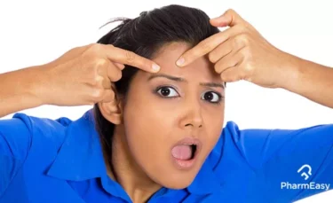 home remedies for acne