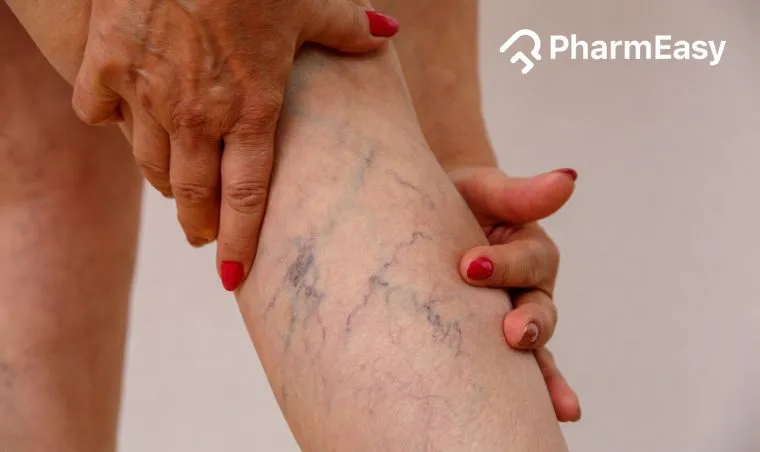 Deep Vein Thrombosis Treatment at Home