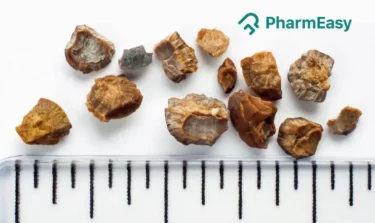 kidney stone removal
