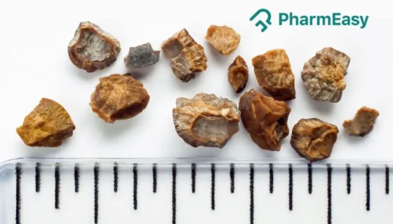 kidney stone removal