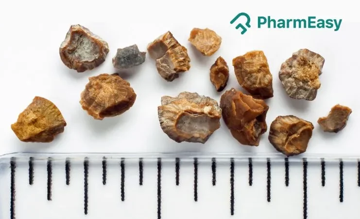 kidney stone removal