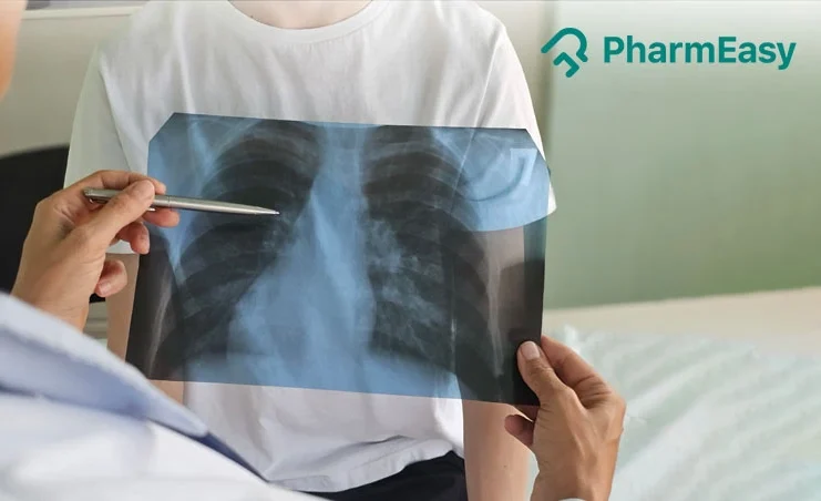 lobar pneumonia